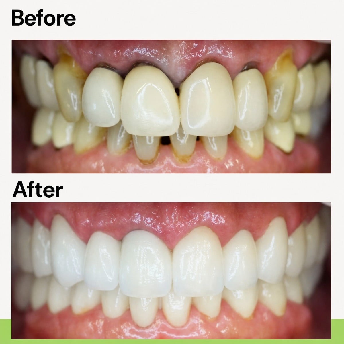 نتائج زراعة الأسنان قبل وبعد في عيادة Evergreen Dental – تحسين الابتسامة ومحاذاة الأسنان