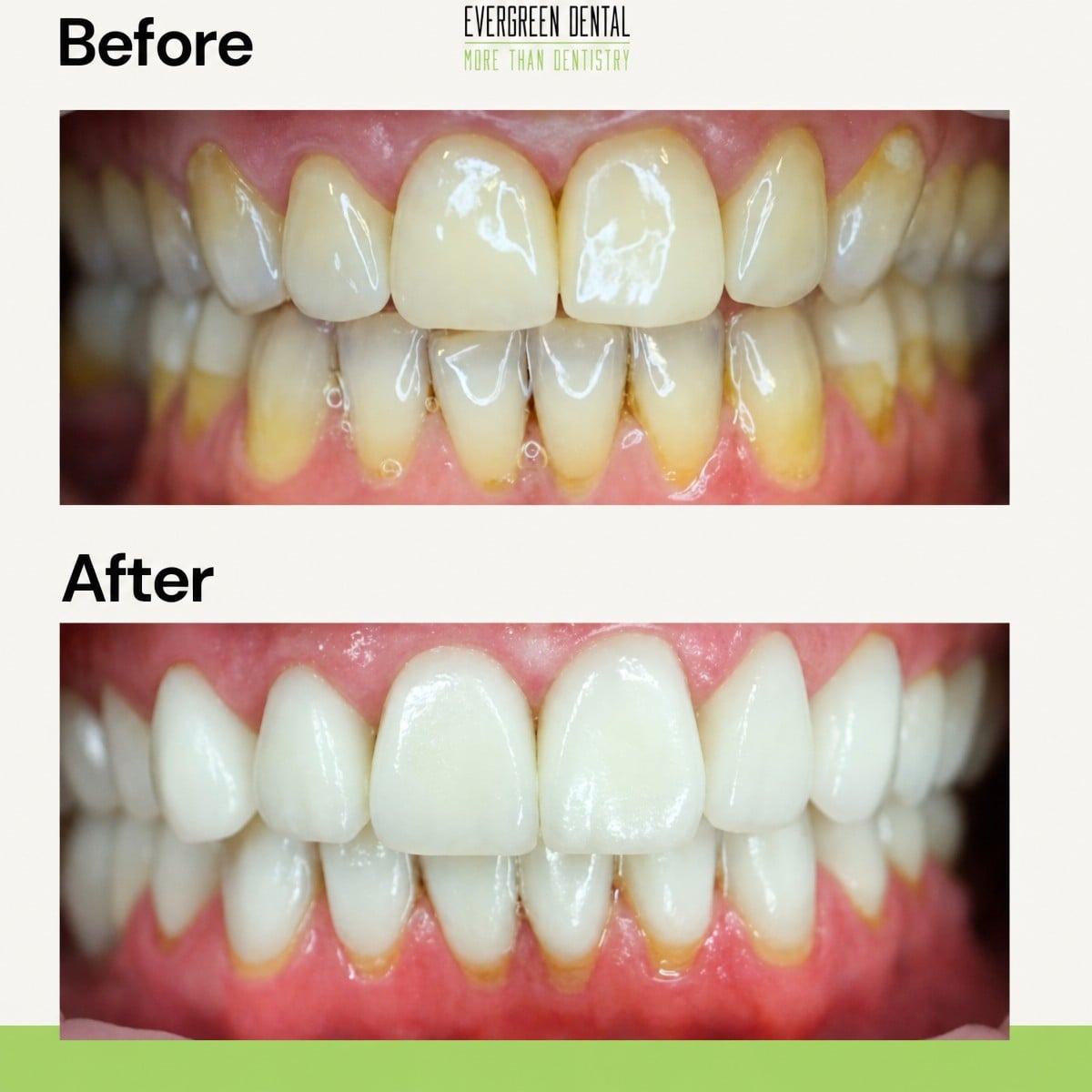 Resultados de implantes dentales antes y después en Evergreen Dental: sonrisa mejorada y dientes más blancos