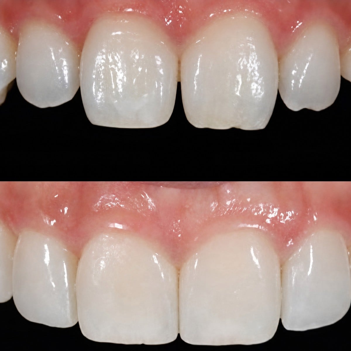 نتائج قبل وبعد عدسات الأسنان بدون تحضير في Yonsei JW Dental Clinic، تحسين جمالية الابتسامة