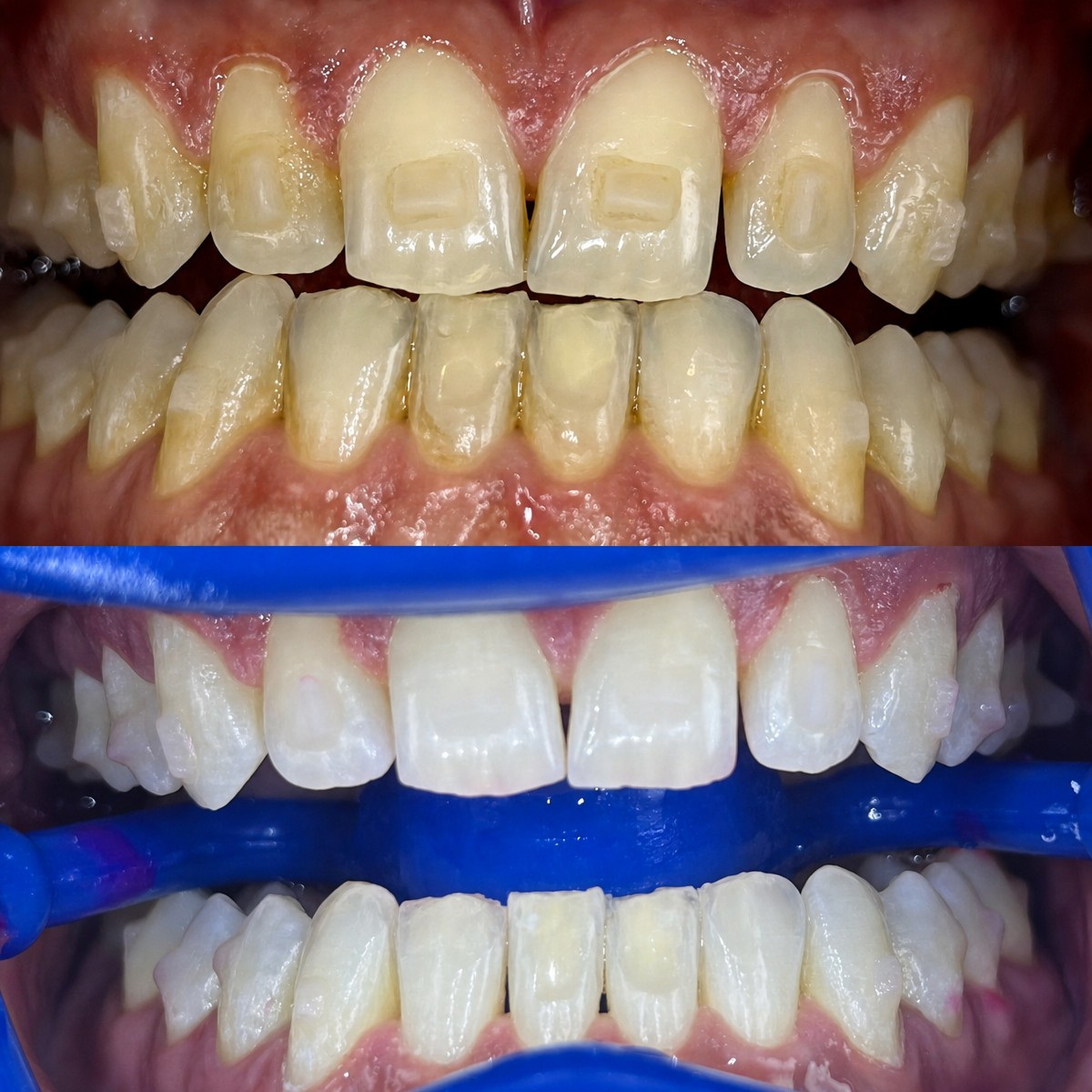 نتائج تبييض الأسنان قبل وبعد في Smile Centrum، أسنان أكثر بياضًا ولمعانًا