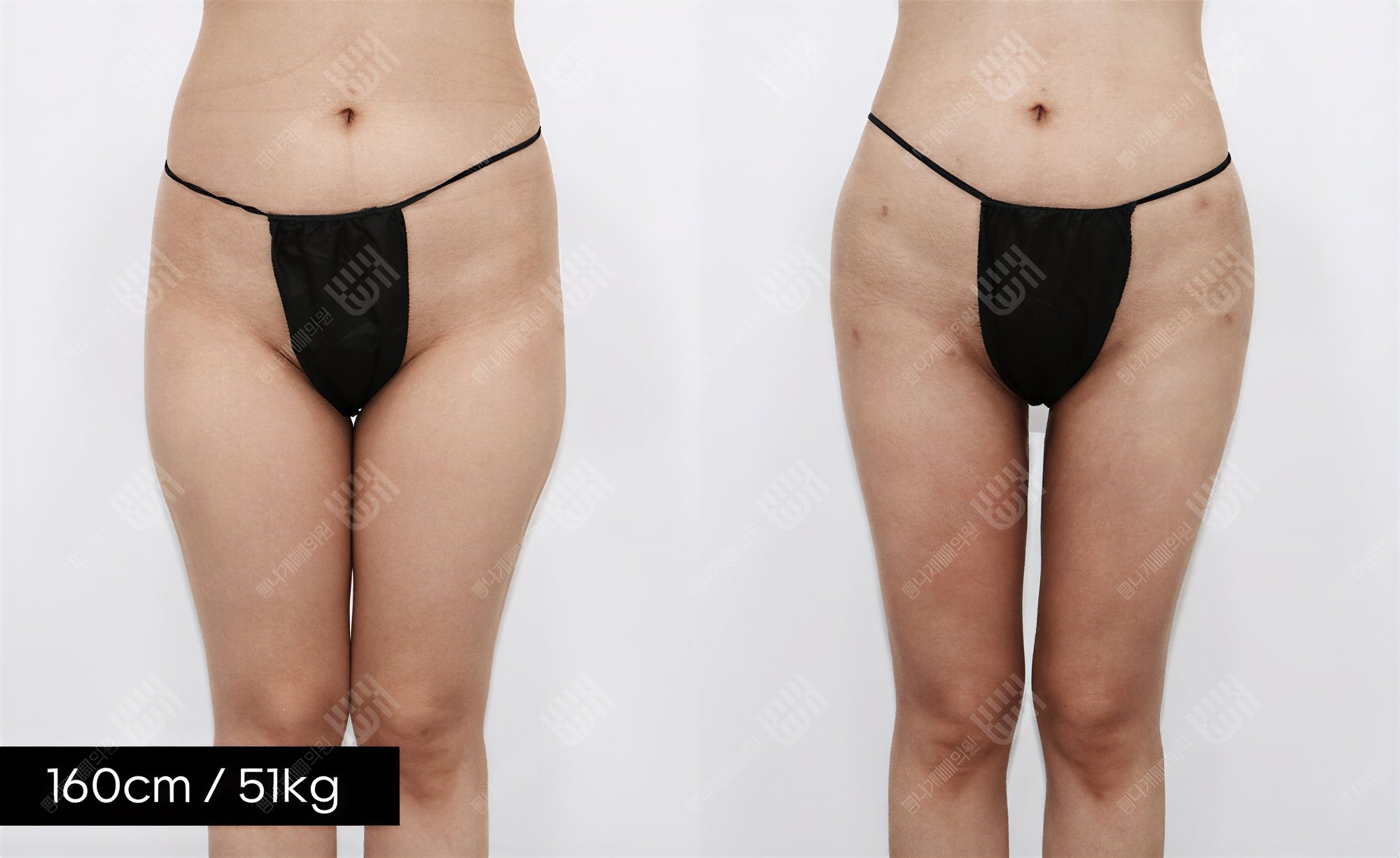 Resultados de liposucción de muslos antes y después en Bbae Clinic – piernas más delgadas