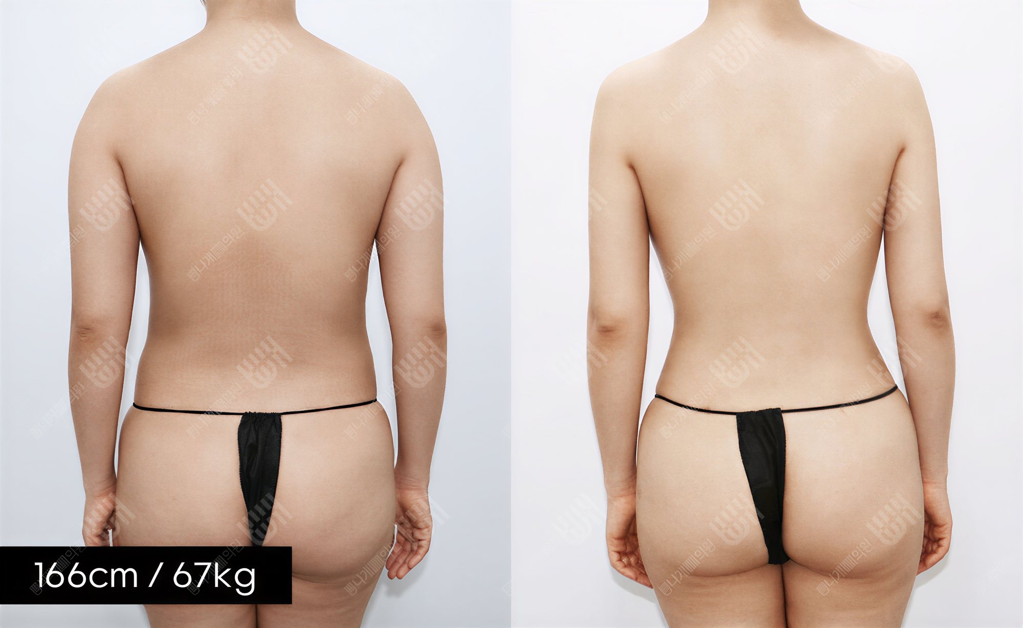 Resultados de liposucción de espalda antes y después en Bbae Clinic, mejor contorno corporal