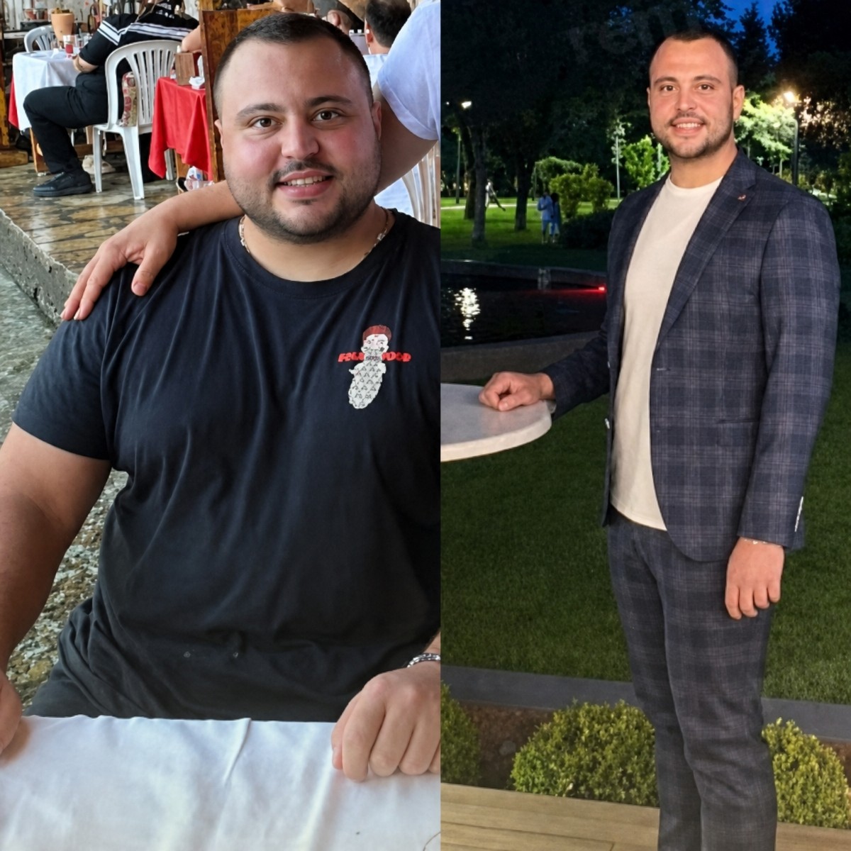 Antes y después de gastroplastia endoscópica en Memorial Şişli Hospital, resultado de pérdida de peso