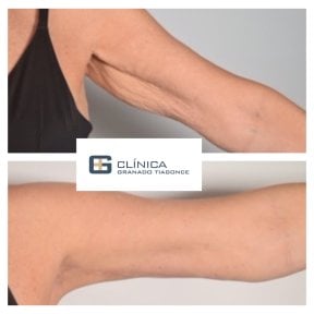Resultados antes y después de lifting de brazos en Clinica Granado Tiagonce, contorno mejorado