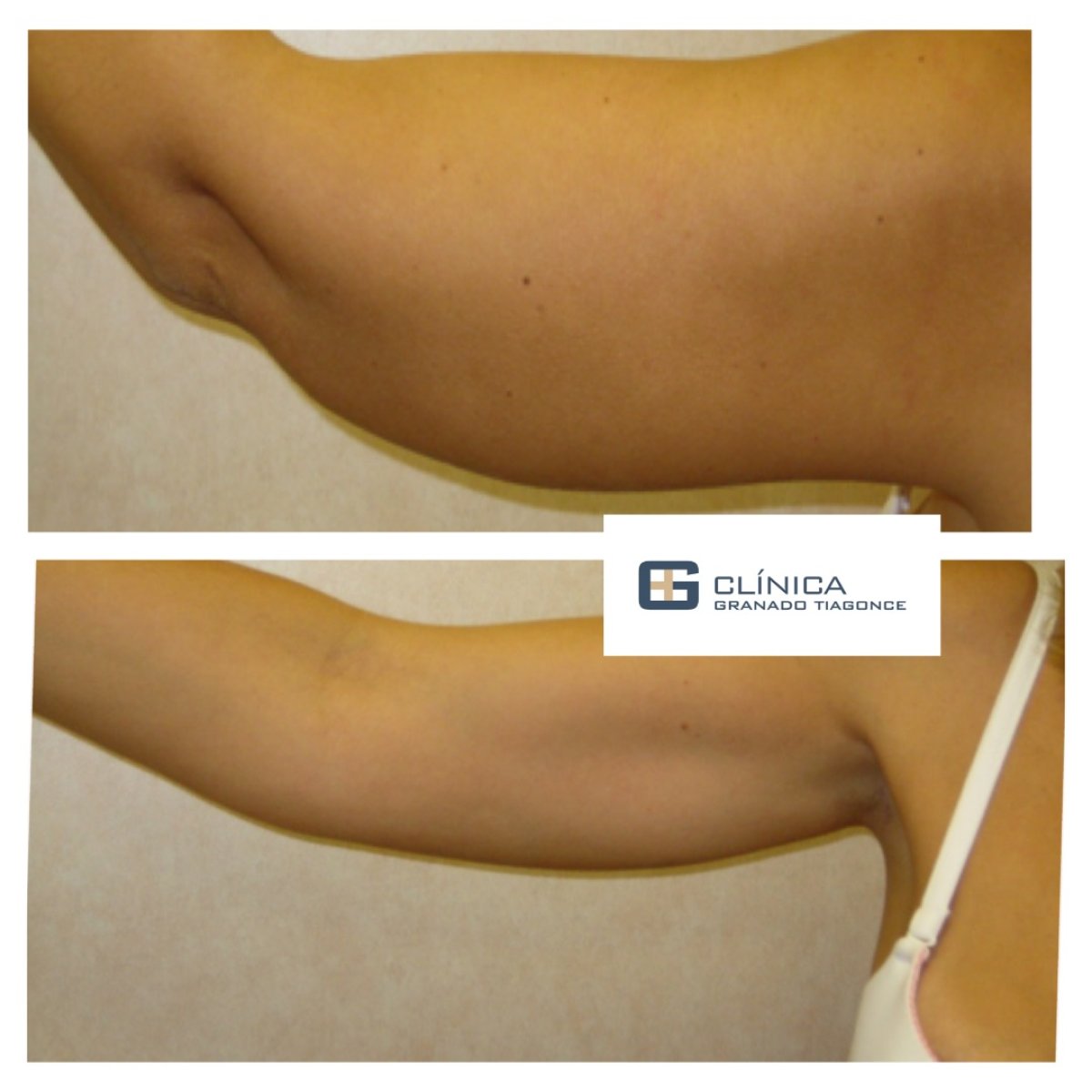 Результаты до и после подтяжки рук в Clinica Granado Tiagonce, улучшенный контур