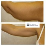 Resultados de lifting de brazos antes y después en Clinica Granado Tiagonce, contorno mejorado