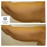 Resultados antes y después de lifting de brazos en Clinica Granado Tiagonce, contorno mejorado