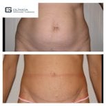 Результати абдомінопластики до і після в Clinica Granado Tiagonce, покращений контур живота