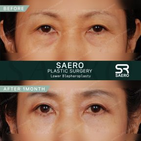 Lower eyelid blepharoplasty before and after results at SAERO Plastic Surgery clinic