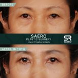 Lower eyelid blepharoplasty before and after results at SAERO Plastic Surgery clinic