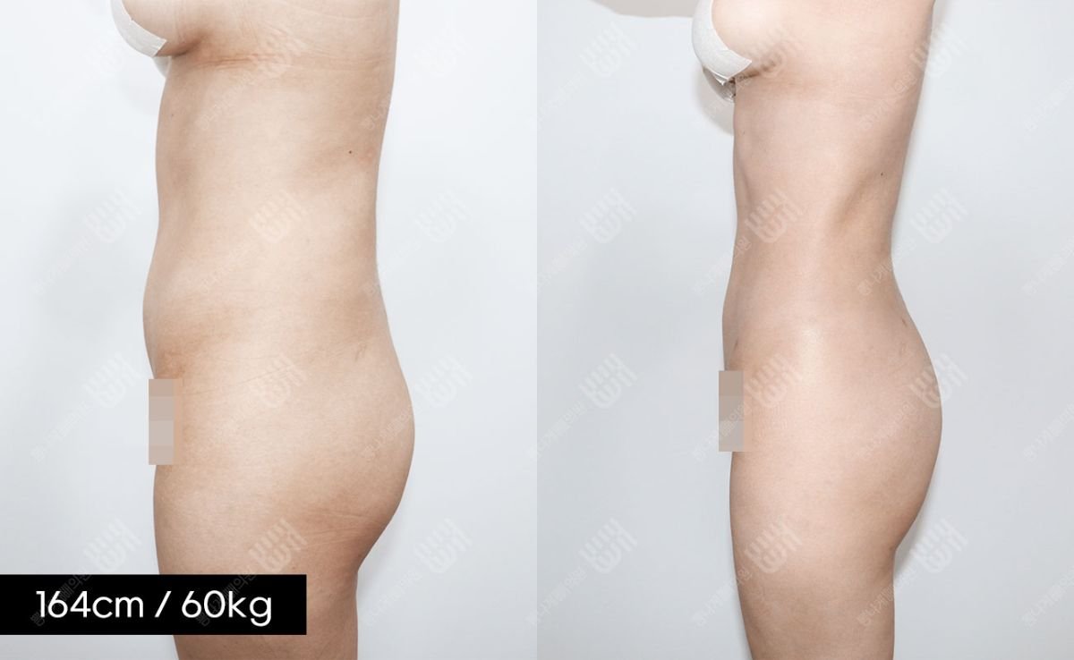 Результаты липосакции живота до и после в клинике Bbae, видимое улучшение контура талии