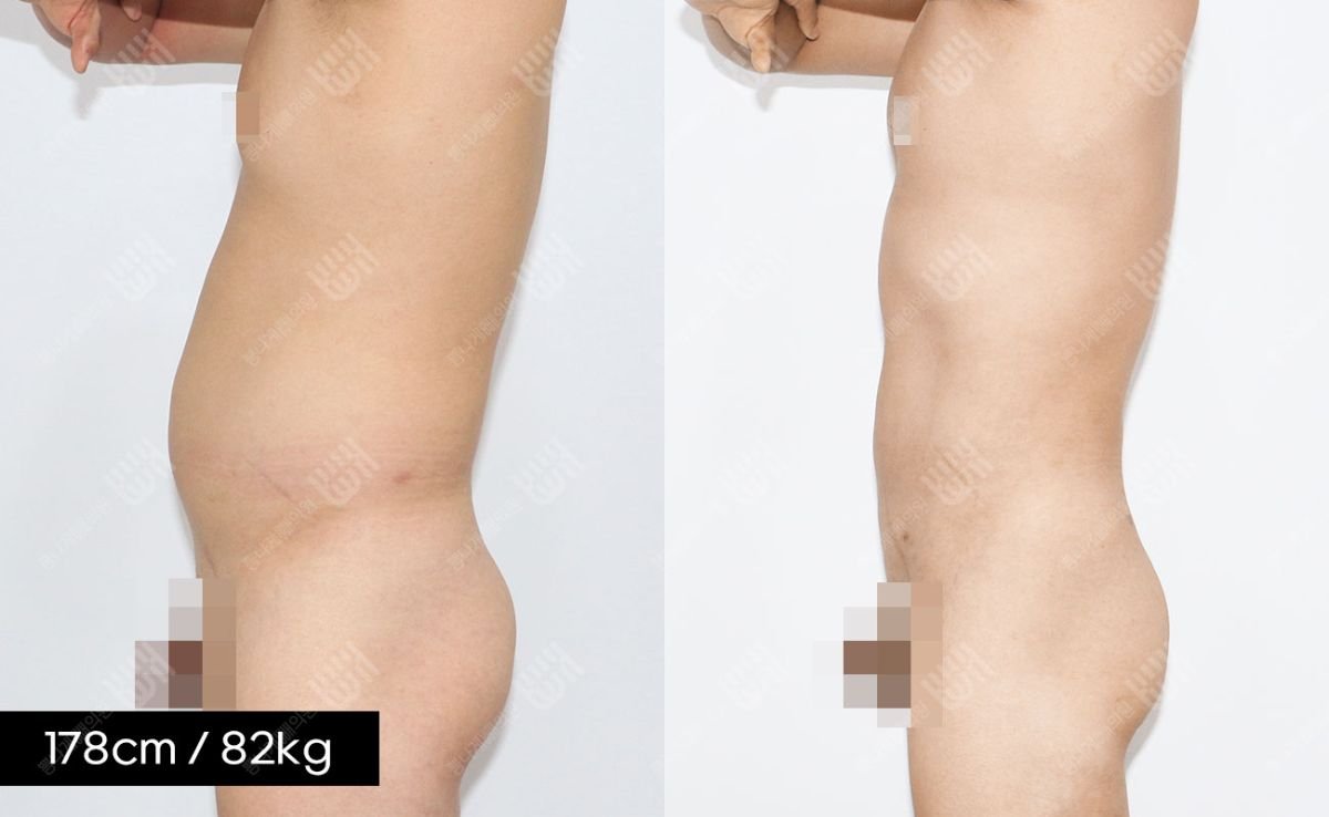 Результаты липосакции живота до и после в клинике Bbae, видимое улучшение контура тела
