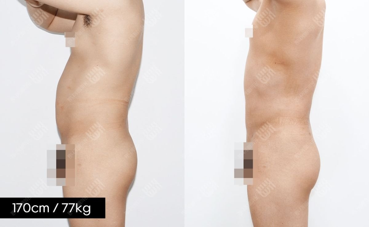 Результаты липосакции живота до и после в клинике Bbae, видимое улучшение контура тела