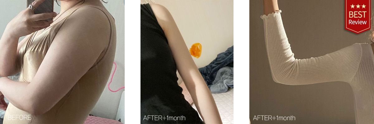 Результаты липосакции верхней части руки в Bbae Clinic – заметно стройнее контур руки