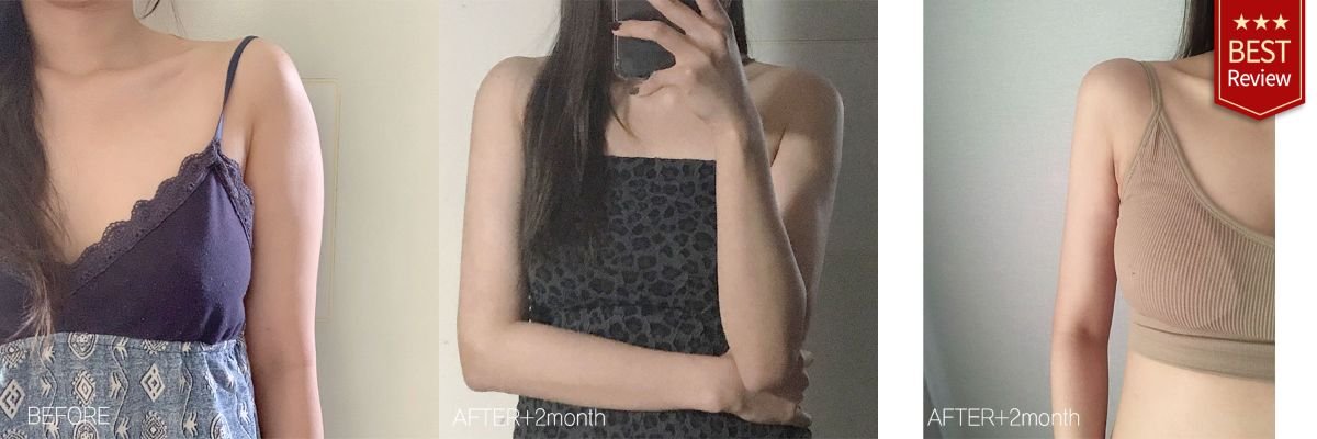 Липосакция рук до и после в клинике Bbae – заметно более стройный контур рук