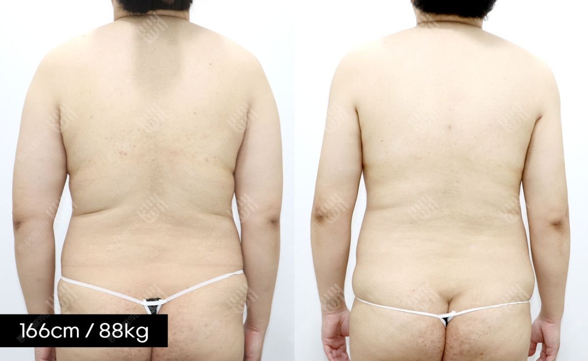 Результати ліпосакції спини до і після в клініці Bbae, помітне зменшення жиру