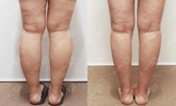 Before and after calf liposuction results at Bbae Clinic, slimmer legs and improved contour
