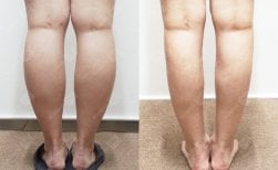 Before and after calf liposuction results at Bbae Clinic – slimmer, contoured lower legs