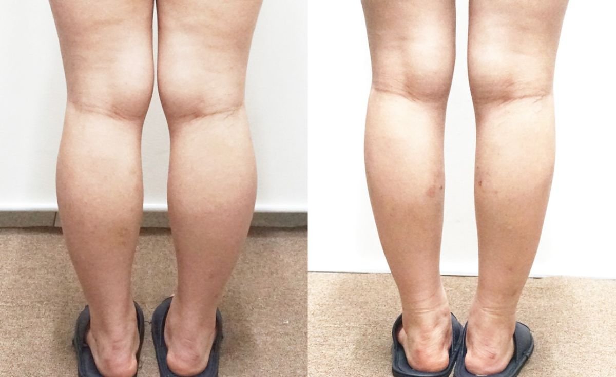 Результат ліпосакції литок до і після в клініці Bbae – стрункі, контурні гомілки