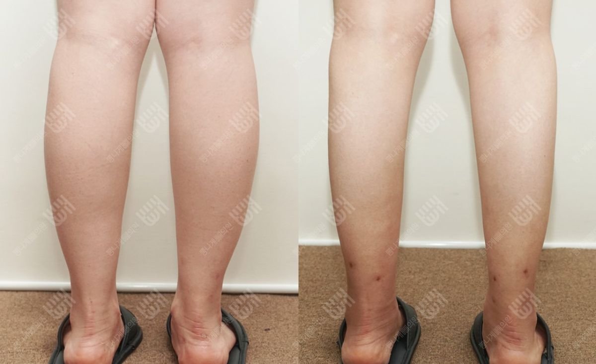 Результати ліпосакції литок до і після в клініці Bbae – стрункіші ноги