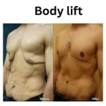 Resultados antes y después de body lift completo en ID Clinic Bangkok, mejor contorno corporal