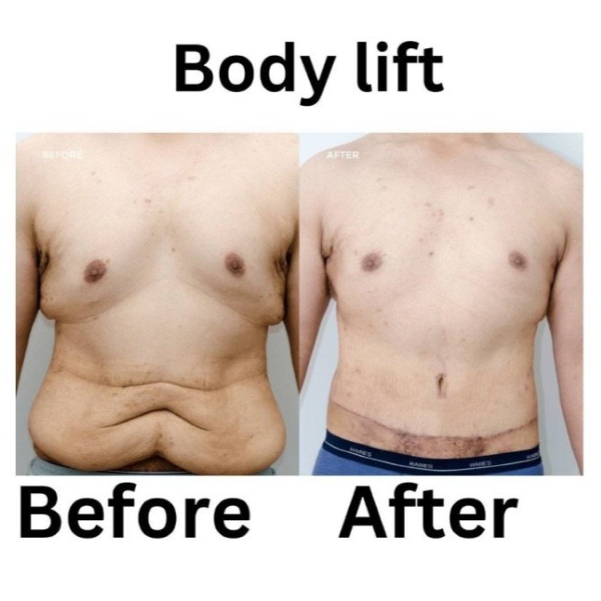 نتائج شد الجسم الكامل قبل وبعد في ID Clinic Bangkok مع تحسين شكل البطن