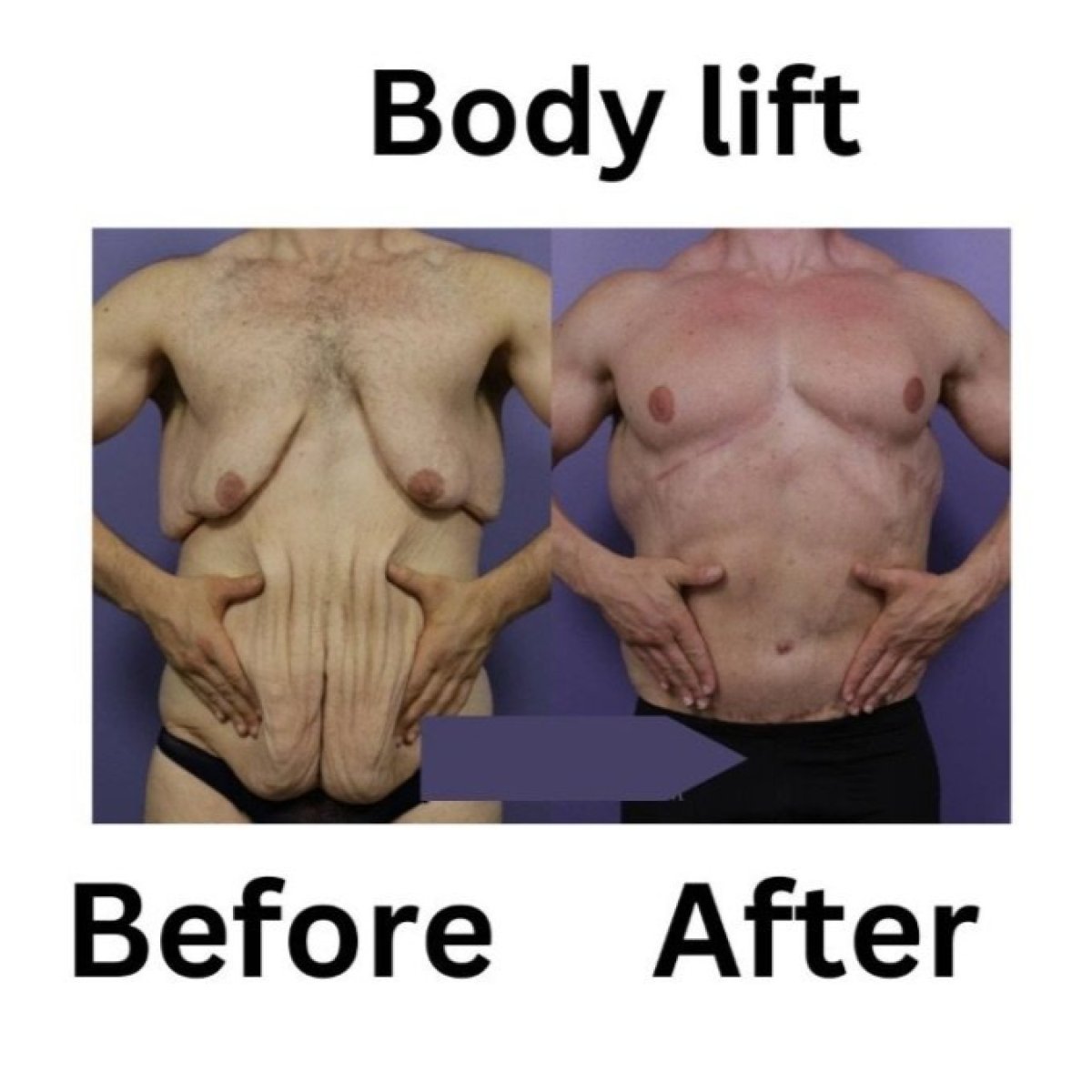 نتائج شد الجسم الكامل قبل وبعد في ID Clinic Bangkok مع تحسين واضح لتناسق الجسم