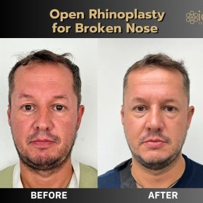 Before and after open rhinoplasty for broken nose at ID Clinic Bangkok, visible nose correction result