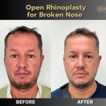 Before and after open rhinoplasty for broken nose at ID Clinic Bangkok, visible nose correction result