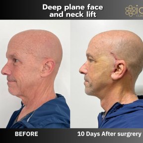 Before and after deep plane facelift and neck lift results at ID Clinic Bangkok, visible lift