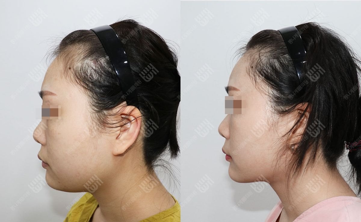 Résultats avant/après liposuccion du visage à la Bbae Clinic – contour du visage affiné