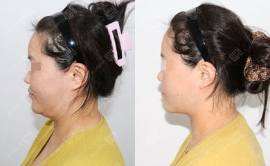 Результаты липосакции лица до и после в клинике Bbae – более четкий овал лица и подбородок