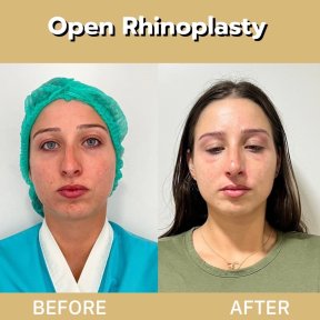 Before and after open rhinoplasty results at ID Clinic Bangkok, nose reshaping improvement