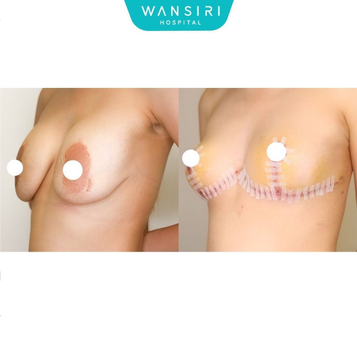 До и после уменьшения груди в Wansiri Hospital, видимый лифтинг и улучшение контура