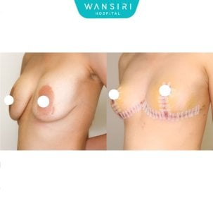 Antes y después de reducción de senos en Wansiri Hospital, resultado de elevación y contorno