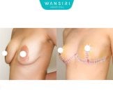 Antes y después de reducción de senos en Wansiri Hospital, resultado de elevación y contorno