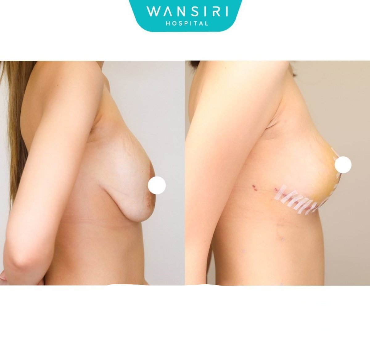 До и после уменьшения груди в Wansiri Hospital, видимый лифтинг и улучшение контура