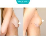 Antes y después de reducción de senos en Wansiri Hospital, mejora visible del contorno