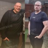 Efekty przed i po operacji rękawowej w Memorial Ankara Hospital, widoczna utrata wagi