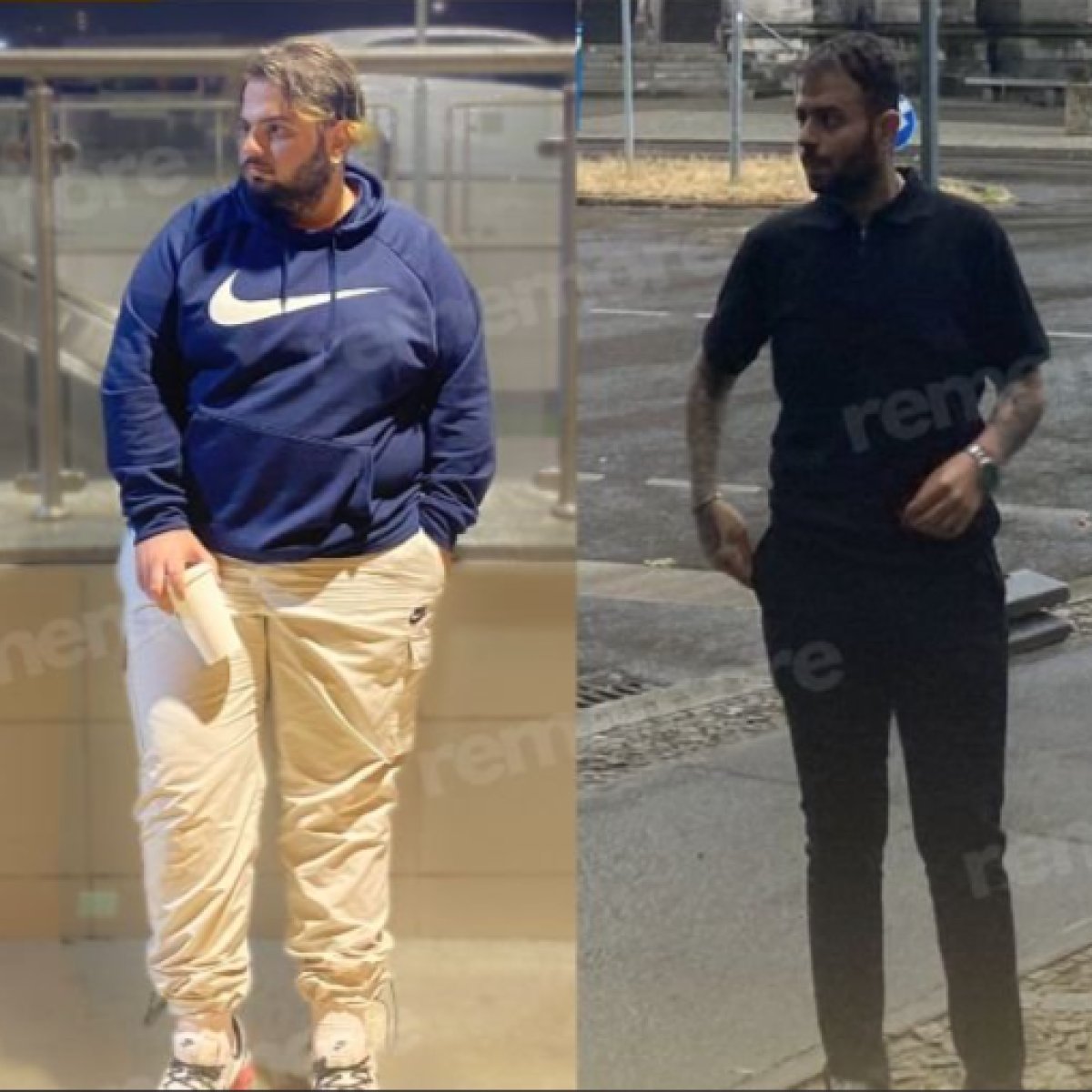 نتائج قبل وبعد تكميم المعدة في مستشفى ميموريال أنقرة، فقدان وزن ملحوظ