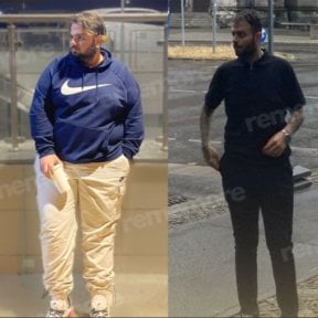 Efekty przed i po operacji rękawowej resekcji żołądka w Memorial Ankara Hospital, widoczna utrata wagi