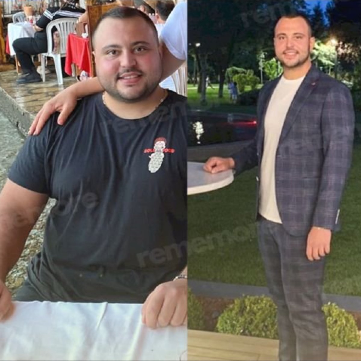 قبل وبعد عملية تكميم المعدة في مستشفى ميموريال أنقرة، نتيجة فقدان وزن واضحة