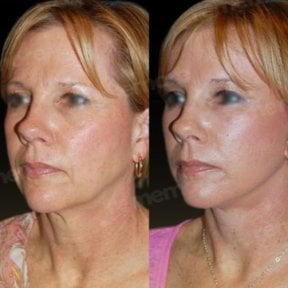 Результаты до и после подтяжки лица в Memorial Ankara Hospital, видимое омоложение