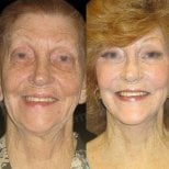 Результаты до и после подтяжки лица в Memorial Ankara Hospital – омоложение лица