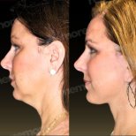 Resultados de lifting facial antes y después en Memorial Ankara Hospital, mejora del cuello