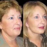 Resultados de lifting facial antes y después en Memorial Ankara Hospital, rejuvenecimiento facial