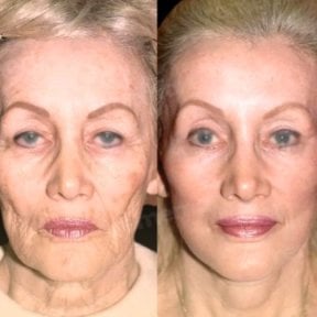 Resultados de lifting facial antes y después en Memorial Ankara Hospital, rejuvenecimiento facial