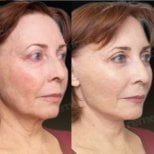 Resultados de lifting facial antes y después en Memorial Ankara Hospital, rejuvenecimiento facial