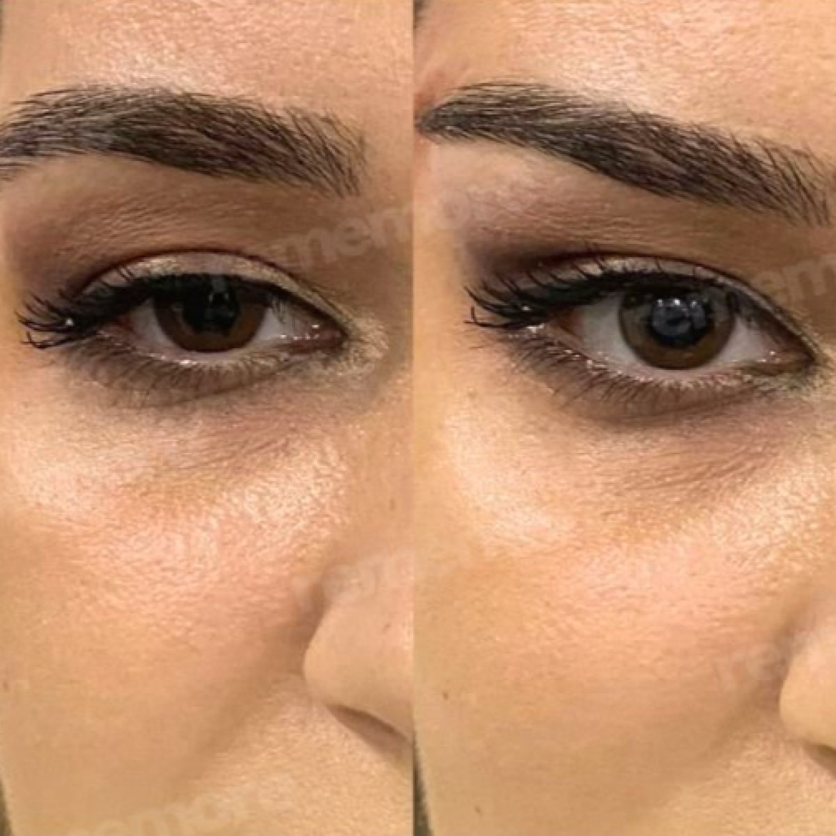 Vorher-nachher-Ergebnisse der Blepharoplastik in Memorial Ankara Hospital, Lidkorrektur