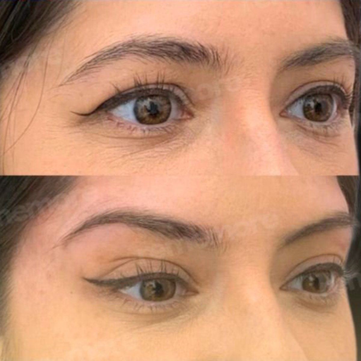 Blepharoplastik Vorher-Nachher-Ergebnis bei Memorial Ankara Hospital, Lidkorrektur